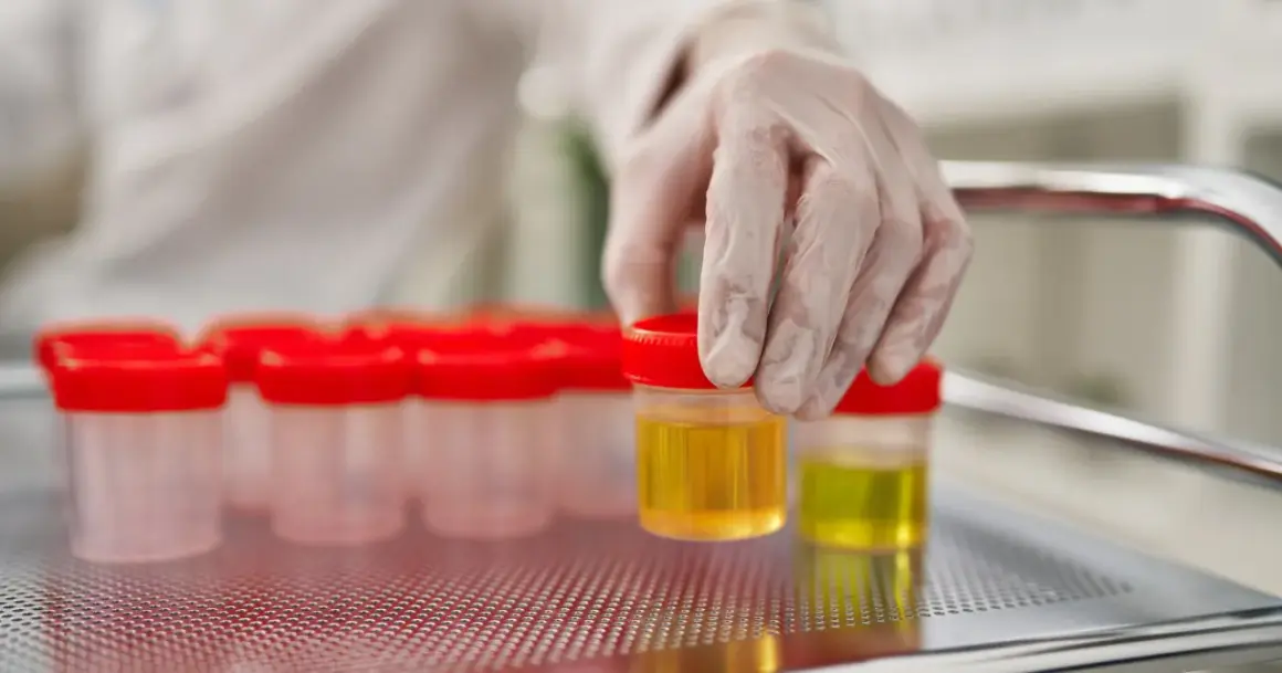 Ręka w rękawiczce laboratoryjnej wybiera pojemnik z żółtym płynem, prawdopodobnie badanie na obecność ketonów w moczu.