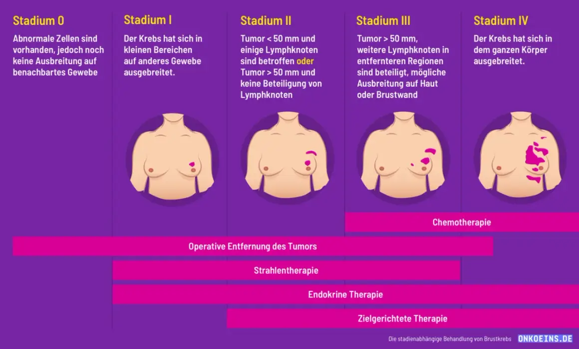 Brustkrebs ist heilbar, je nach Stadium. Die Grafik zeigt Stadien 0-IV und Behandlungsoptionen wie Chemotherapie.