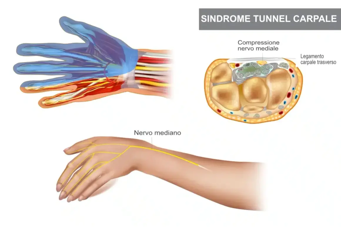 Illustrazione sindrome tunnel carpale: anatomia mano, nervo mediano compresso. Valutare ghiaccio o calore per alleviare il dolore.