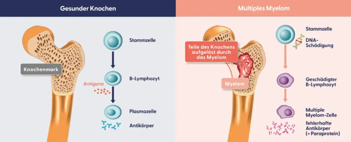 Vergleich gesunder Knochen mit Multiplem Myelom. Myelomzellen schädigen Knochen und produzieren fehlerhafte Antikörper, was zu Knochenschäden und Begleiterkrankungen führt.