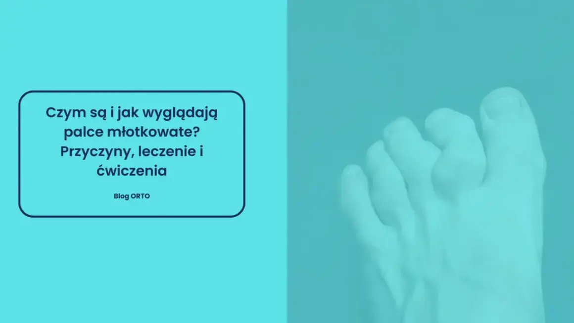 Palce młotkowate: przyczyny, leczenie i ćwiczenia. Widok stopy z zdeformowanymi palcami.
