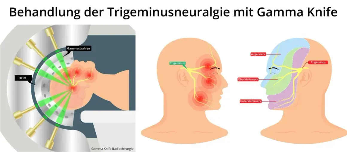 Darstellung der Gamma Knife Bestrahlung zur Behandlung von Trigeminusneuralgie. Grüne Strahlen zielen auf den Trigeminusnerv.