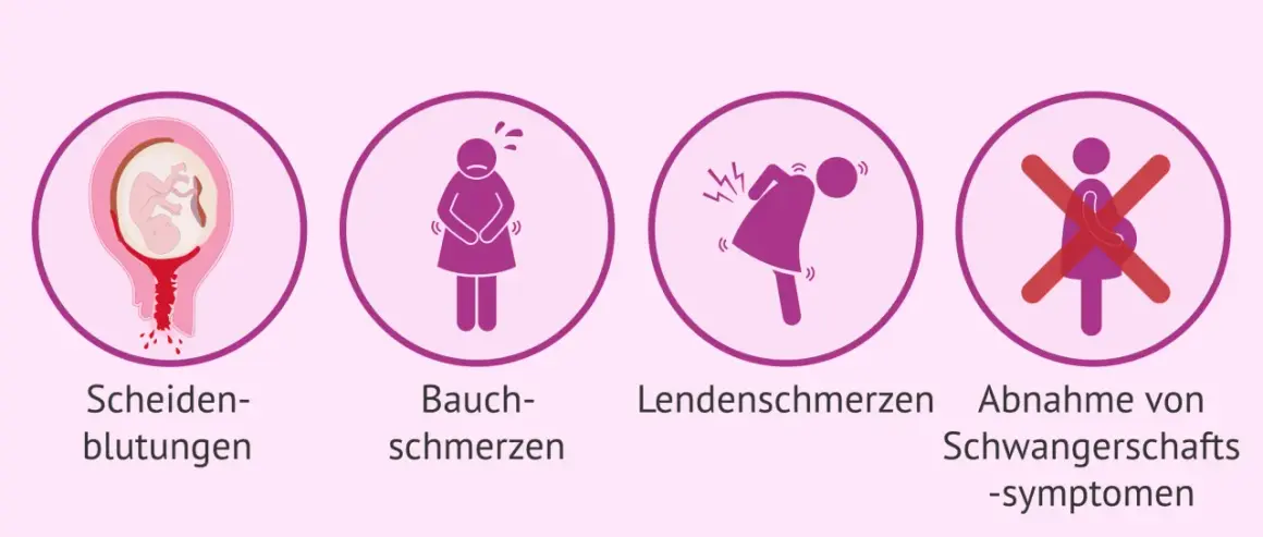 Anzeichen einer Fehlgeburt in der 17. SSW: Blutungen, Bauchschmerzen, Rückenschmerzen, Abnahme von Schwangerschaftssymptomen.