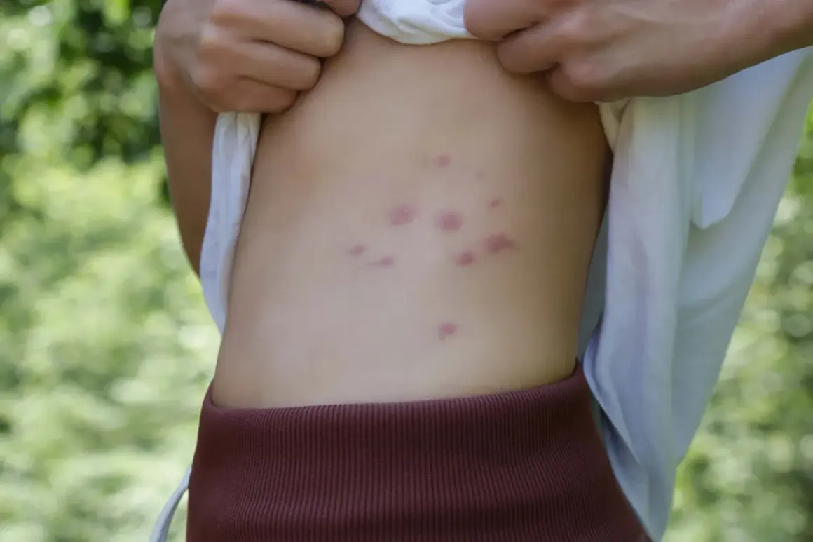 Picaduras de pulgas en humanos: síntomas, tratamiento y prevención eficaz