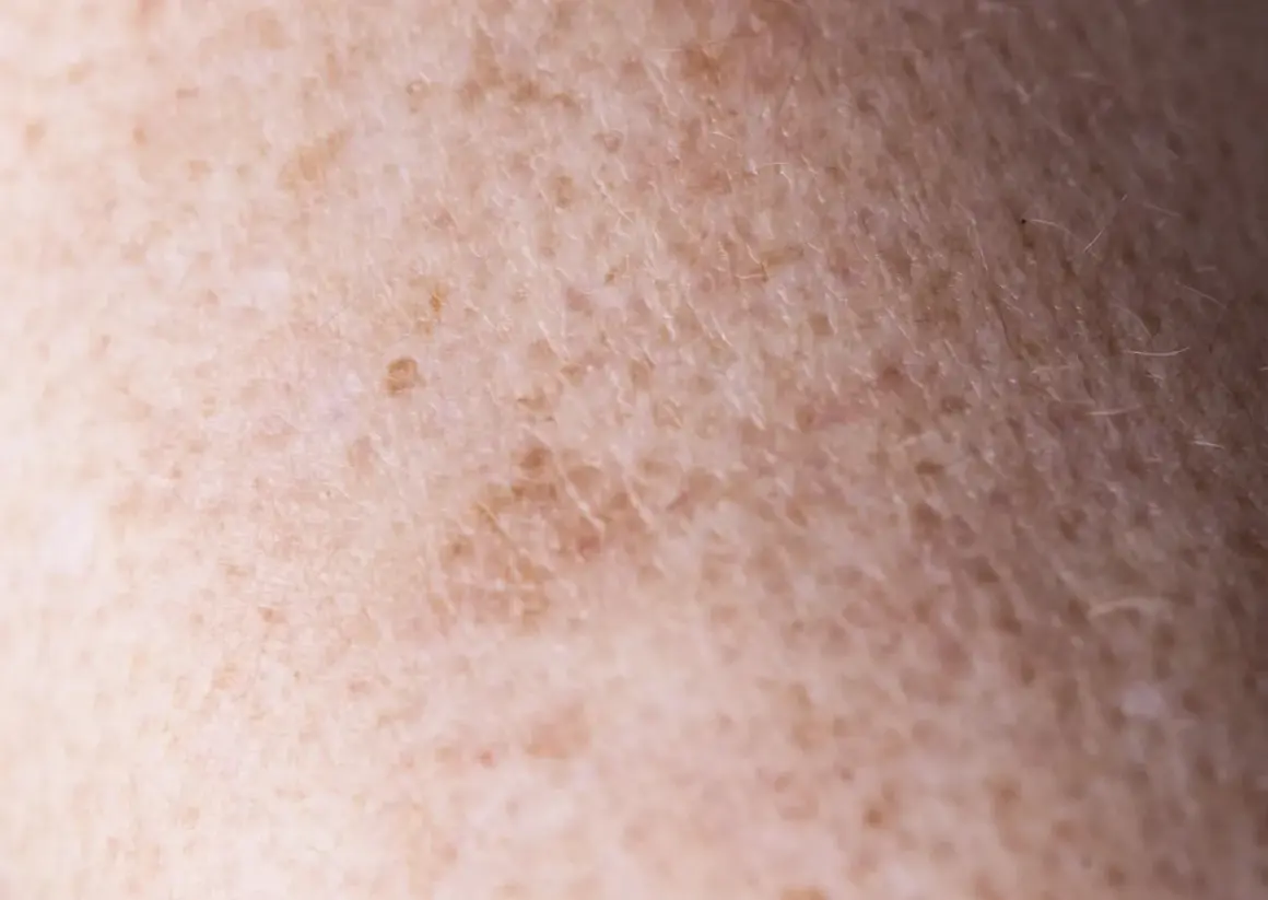 Zbliżenie na skórę z przebarwieniami, gdzie widać nierównomierne rozmieszczenie melaniny. To właśnie melanina co to jest, decyduje o kolorze skóry.