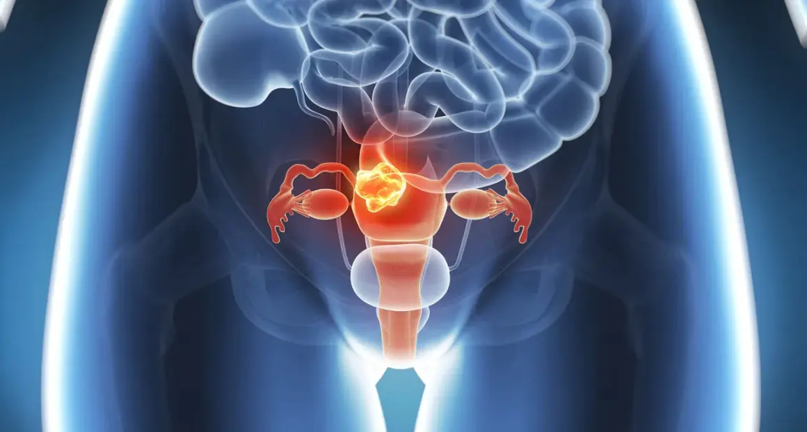 Illustration des weiblichen Beckens mit Fokus auf die Gebärmutter, die einen Tumor zeigt. Dies illustriert die Leitlinie Endometriumkarzinom.