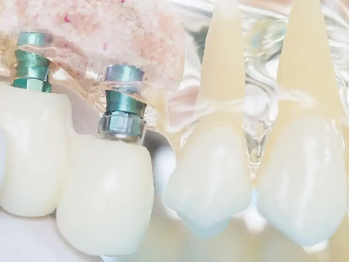 Model szczęki z implantami i koronami. Widoczne są metalowe śruby i białe zęby, sugerujące odrzucenie implantu zęba.