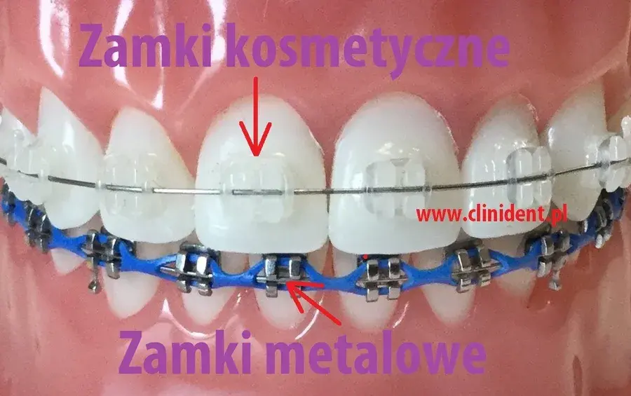 Aparat na zęby: zobacz, jak wygląda! Od metalu po niewidoczne