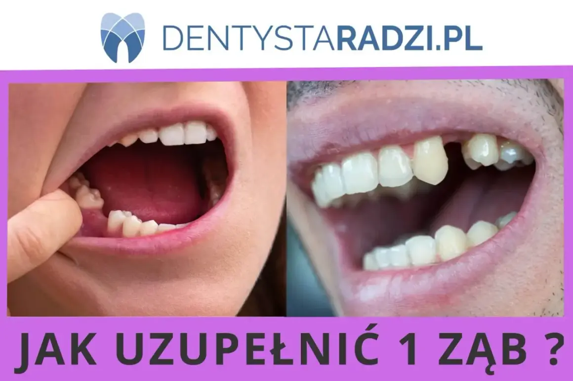 Widoczne ubytki zębów, jeden z nich jest widocznie brakujący. Pytanie brzmi: "Jak uzupełnić 1 ząb?".