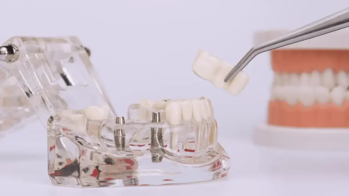 Model szczęki z implantami, na którym pęseta trzyma gotową koronę na implancie.