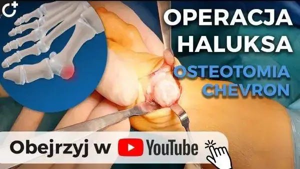 Operacja haluksów: Wybierz klinikę i metodę. Poradnik.