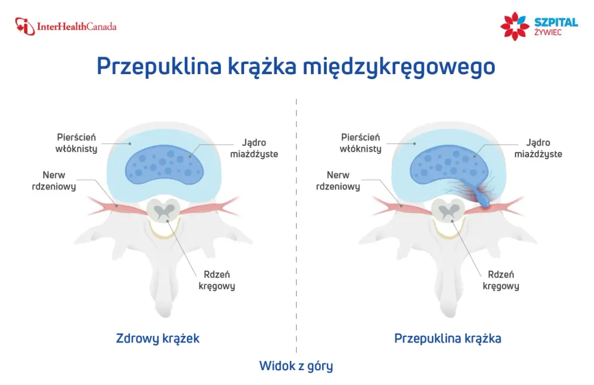 Porównanie zdrowego krążka międzykręgowego i krążka z wypukliną uciskającą nerw rdzeniowy. Widok z góry.