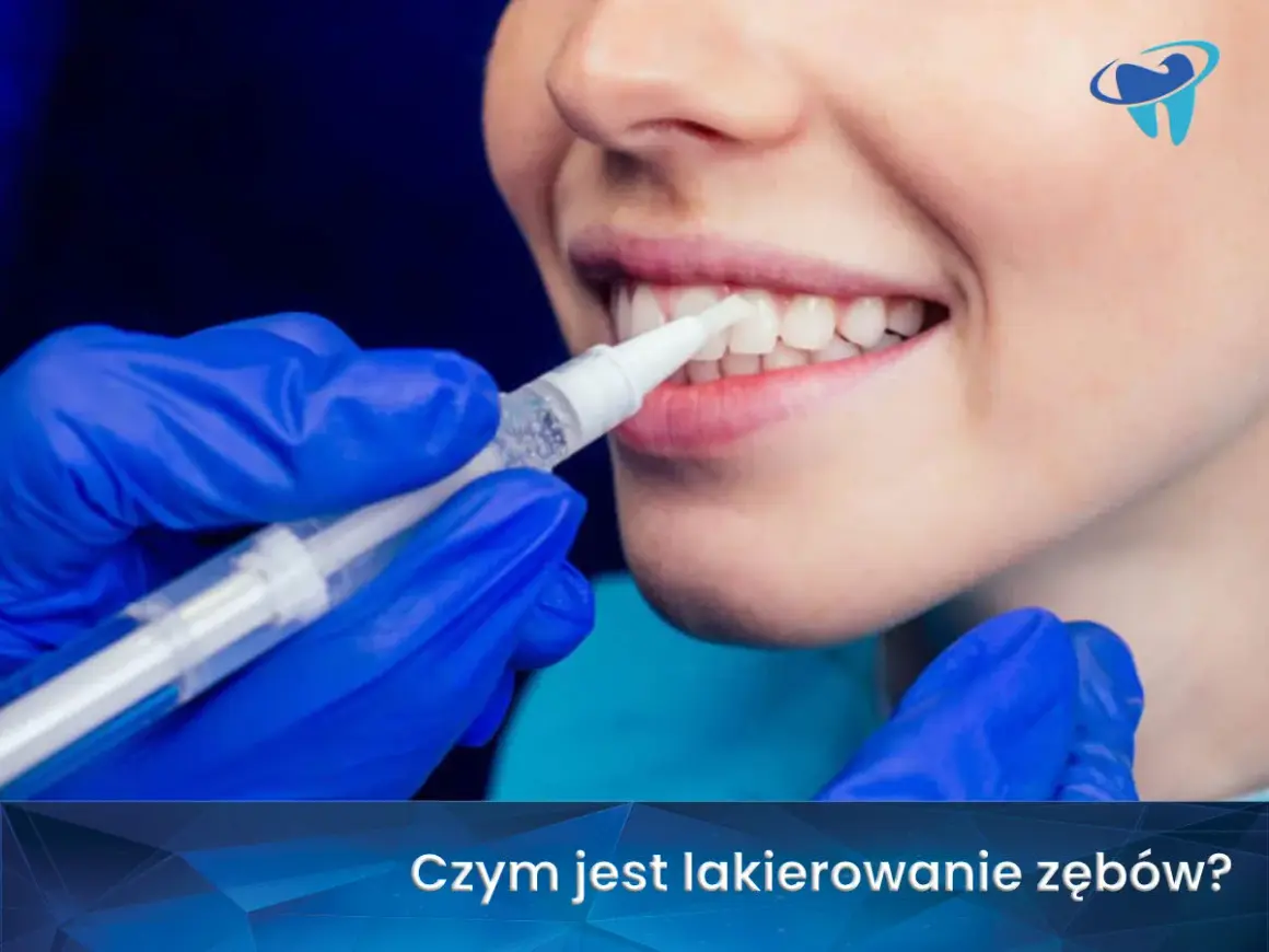 Profesjonalne lakierowanie zębów u dorosłych. Dentysta aplikuje środek wybielający na zęby pacjentki.