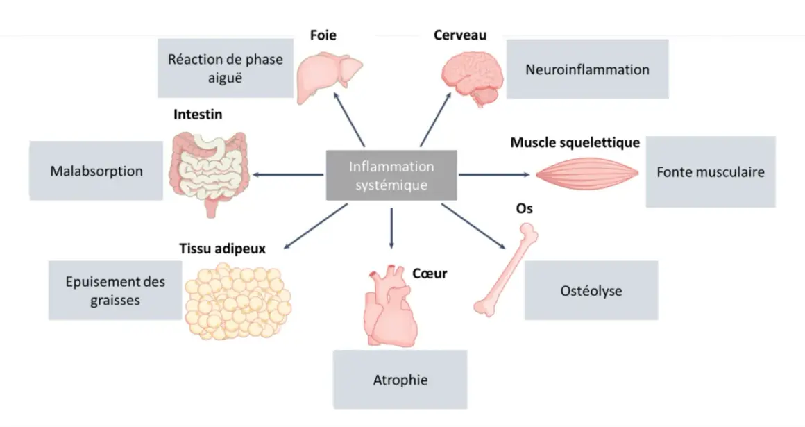 Schéma montrant l'inflammation systémique affectant le muscle squelettique, entraînant une fonte musculaire. D'autres effets incluent le cerveau, le foie, le cœur, les os, l'intestin, le tissu adipeux et la réaction de phase aiguë.