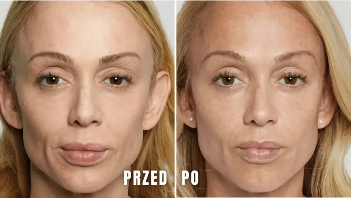 Przed i po zabiegu z użyciem kwasu polimlekowego stymulatora. Skóra twarzy jest gładsza, bardziej napięta i odmłodzona.
