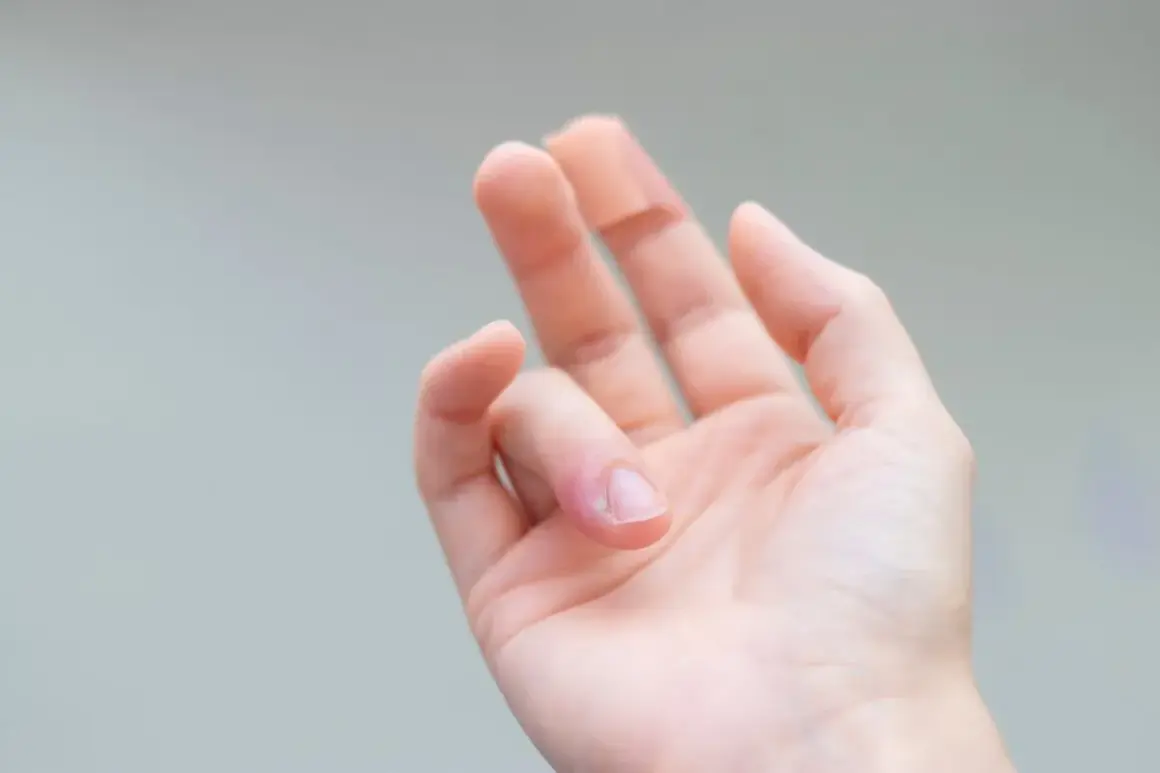Mano con dito arrossato e gonfio, segno di infiammazione dita mano.
