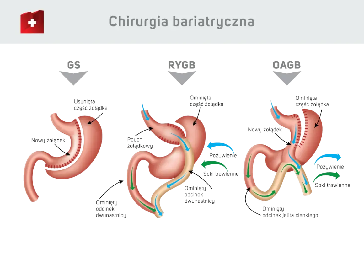 Ilustracja przedstawia trzy typy operacji bariatrycznej: GS, RYGB i OAGB, pokazując zmiany w żołądku i jelitach.