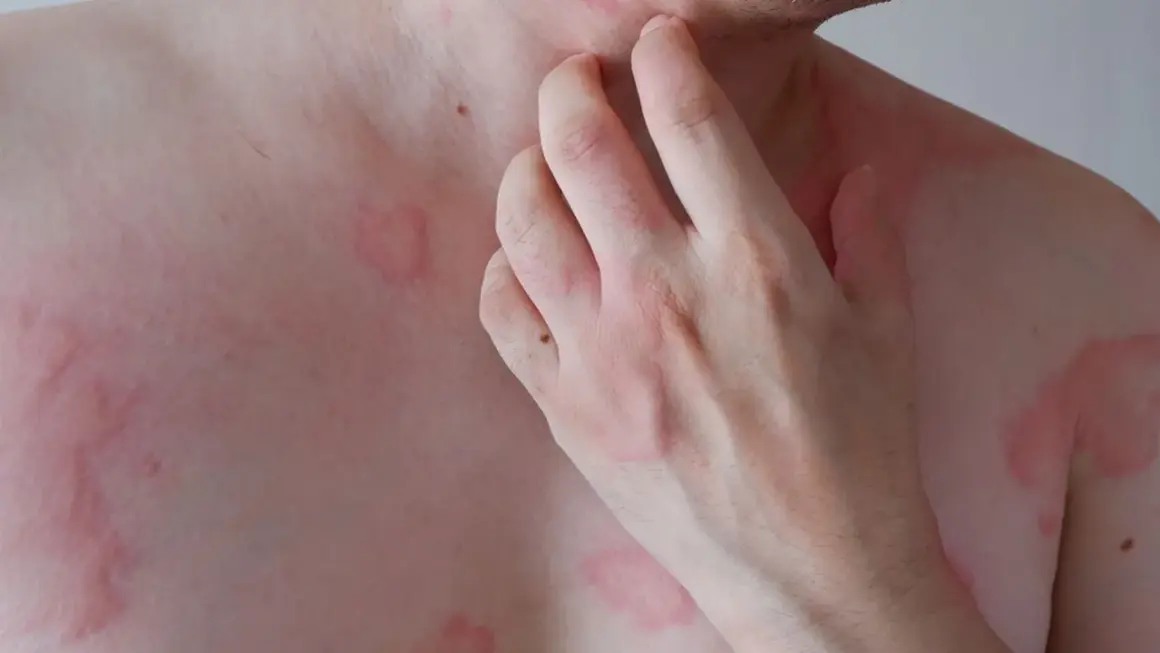 Skóra z zaczerwienionymi, swędzącymi zmianami, dłoń drapiąca kark.
