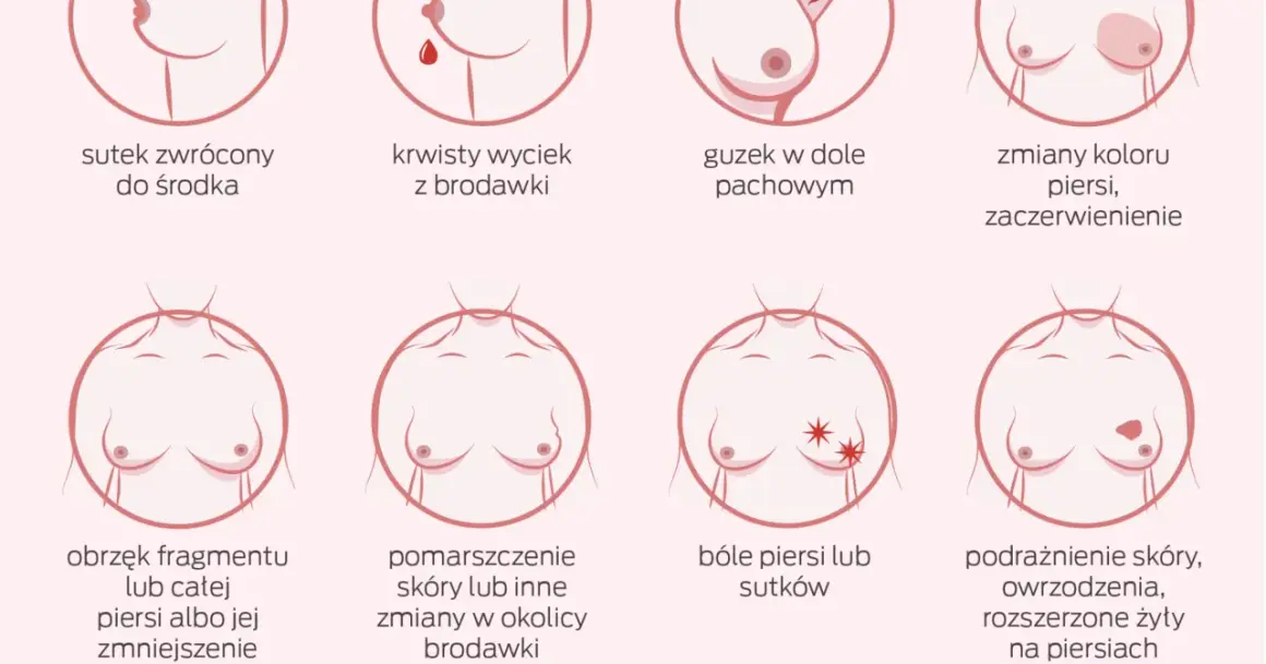 Ilustracja pokazuje objawy, które mogą wskazywać na nowotwór złośliwy sutka: zmiany brodawki, guzek, obrzęk, zaczerwienienie, ból.