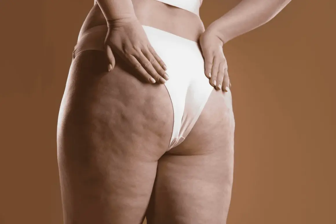 Dettaglio della coscia e del gluteo con cellulite, un'immagine che stimola la riflessione su come eliminare la cellulite e migliorare la propria pelle.
