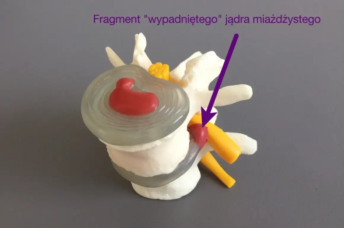 Model kręgosłupa z wypadniętym jądrem miażdżystym, wskazującym na potrzebę zaleceń po nastawianiu kręgosłupa.