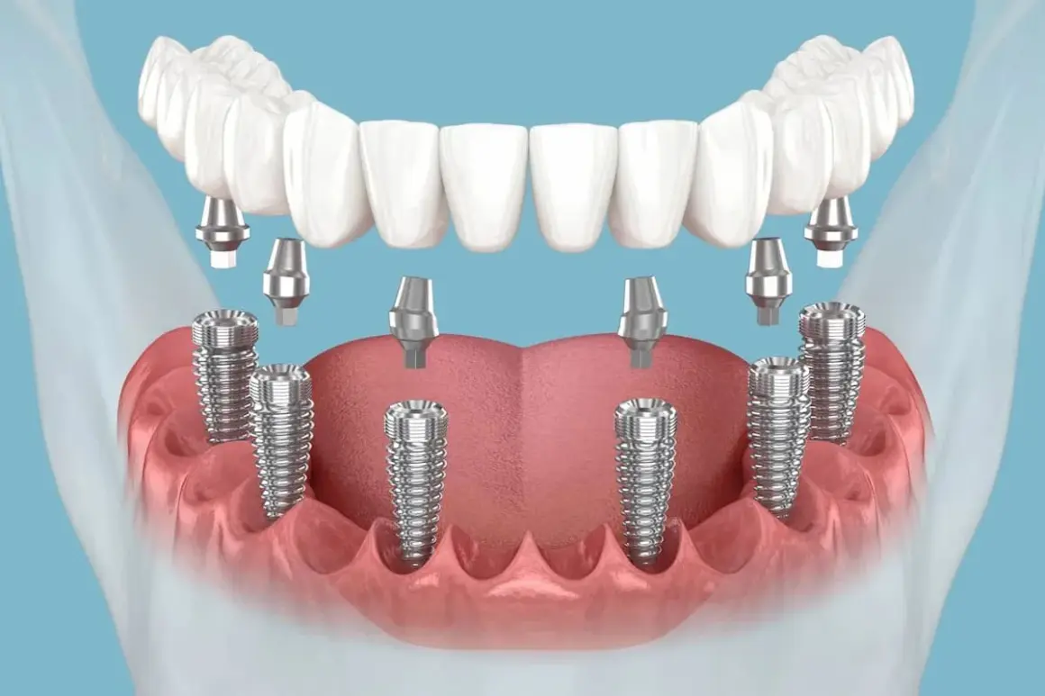 Zęby w jeden dzień cennik: wizualizacja implantów stomatologicznych i protezy górnej szczęki.