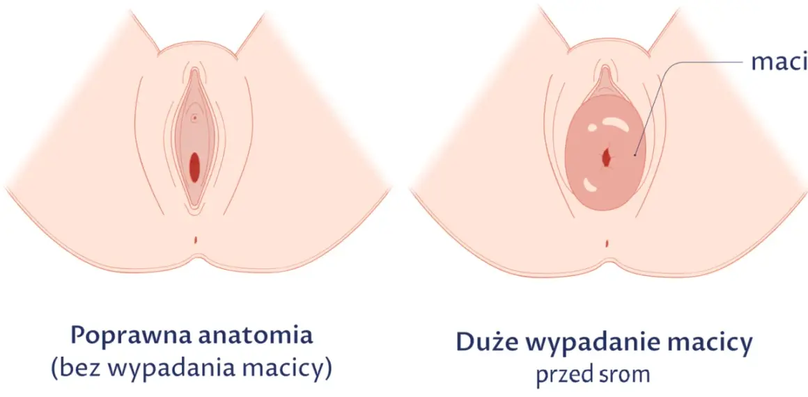 Obniżona macica po porodzie: 7 objawów, które musisz znać