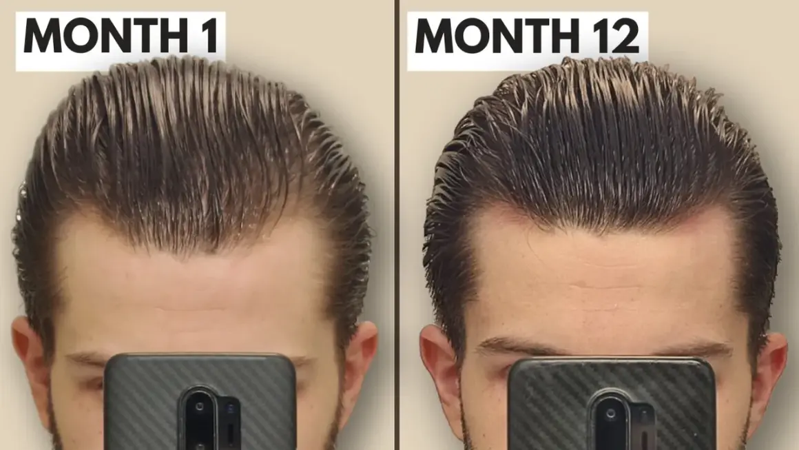 Comparaison avant/après 12 mois : le derma roller a visiblement densifié la chevelure et réduit la perte de cheveux sur le front.