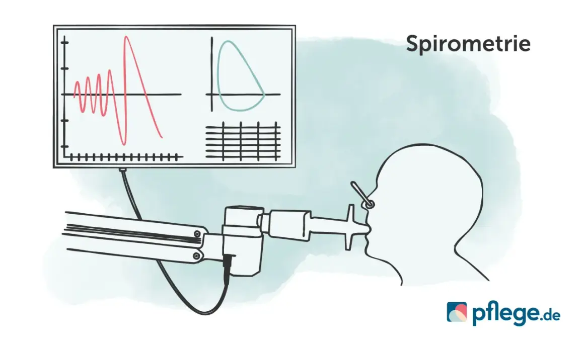 Spirometrie-Diagramm zeigt Lungenfunktion. Bei COPD Gold 3 ist der GdB oft hoch.