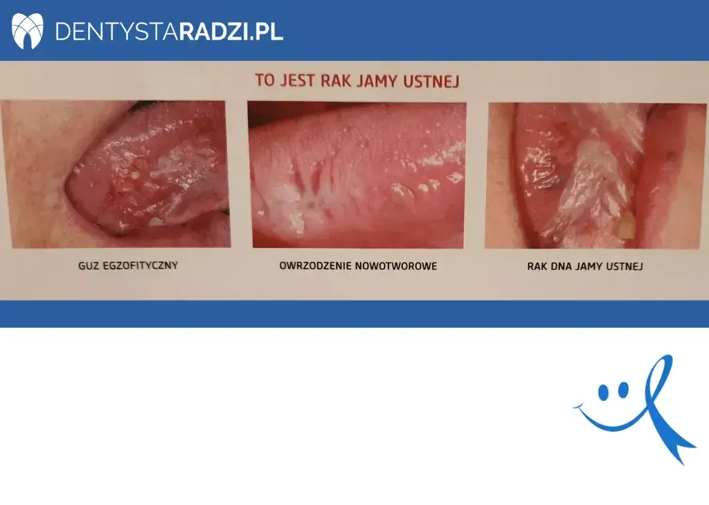 Objawy nowotworu jamy ustnej: Wczesne sygnały ratujące życie