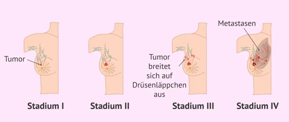 Illustrationen zeigen Stadien von Brustkrebs. Frühe Symptome wie ein Tumor im Stadium I können sich ausbreiten und Metastasen bilden.