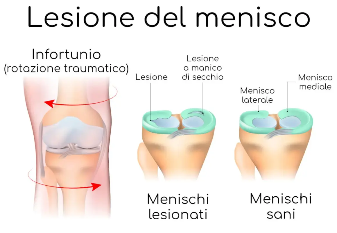 Illustrazione di un ginocchio con menisco lesionato a causa di un infortunio da rotazione. Confronto tra menischi sani e lesionati.