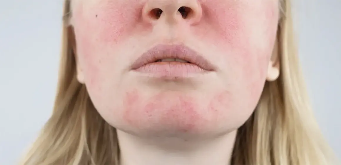Primo piano del viso di una donna con pelle irritata e arrossata sulle guance e sul mento.