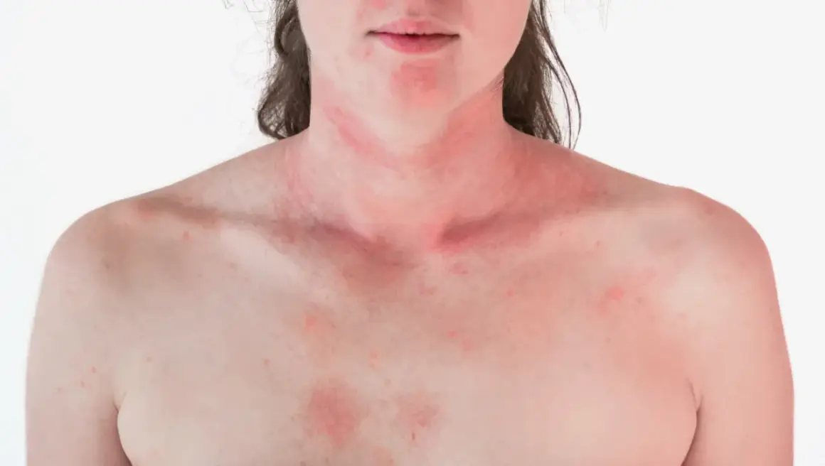 Rötungen und Ausschlag auf der Haut nach Bestrahlung der Brust. Die Haut ist gereizt und zeigt rote Flecken.