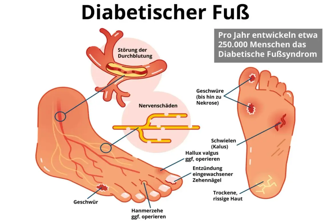 Illustration zeigt einen Fuß mit Anzeichen des diabetischen Fußsyndroms: Geschwüre, Nervenschäden und Durchblutungsstörungen. Ein kleiner Zeh zeigt erste Anzeichen.