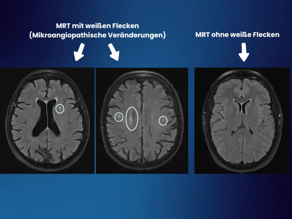 MRT-Aufnahmen zeigen weiße Flecken im Gehirn, die auf mikroangiopathische Veränderungen hindeuten. Diese können fazekas 2 symptome verursachen.