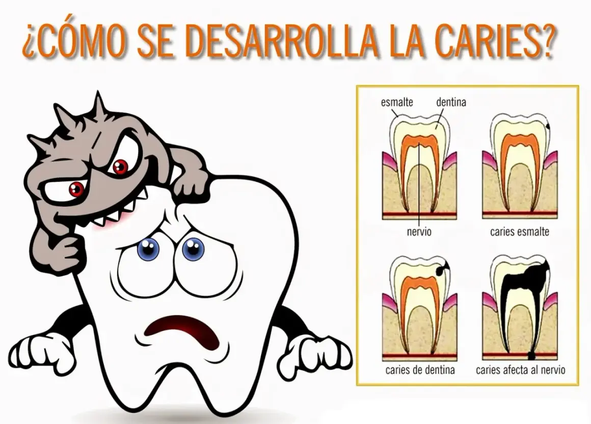 Monstruo atacando un diente triste. Diagramas de etapas de caries dental.
