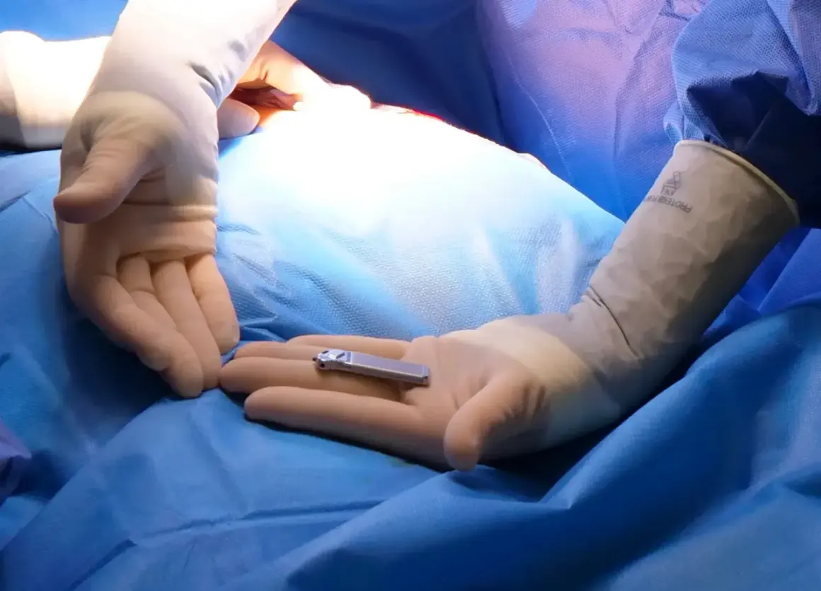 Main chirurgicale : un petit implant, le stimulateur du nerf sacré pour la vessie, est tenu dans une main gantée. Il peut y avoir des inconvénients.