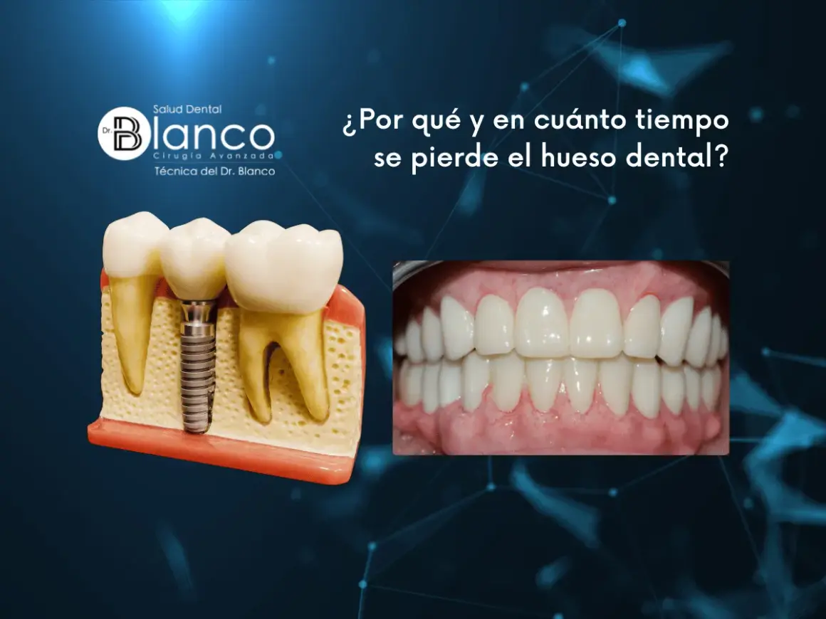 Modelo dental muestra implante y dientes. Foto de sonrisa perfecta. Información sobre cómo recuperar hueso encias.