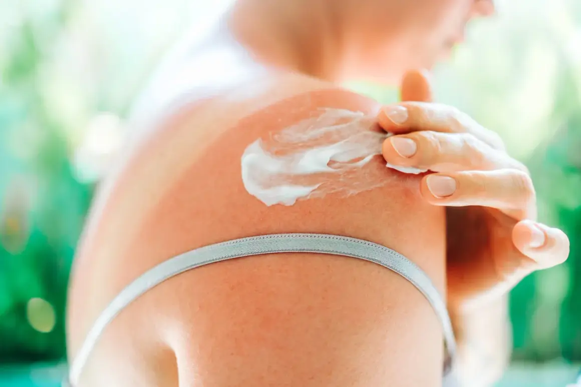 Una mano applica crema doposole su una spalla arrossata dal sole. Utile per lenire e idratare la pelle dopo l'esposizione solare.