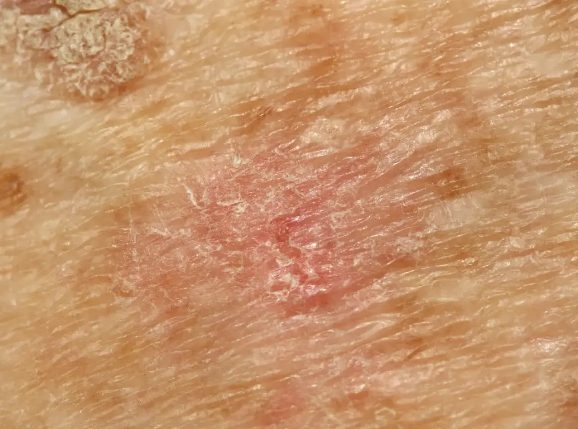 Nahaufnahme von Haut mit Rötung und Schuppung, typisch für aktinische Keratose.