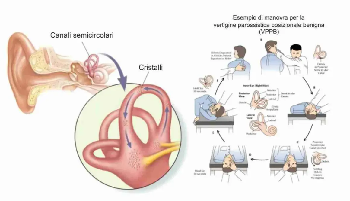 Illustrazione dell'orecchio interno e manovra per le vertigini parossistiche posizionali (VPPB), con i canali semicircolari e i cristalli.