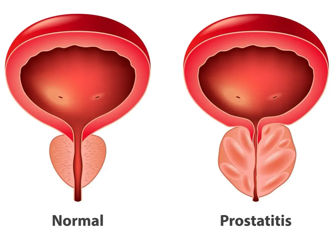Porównanie pęcherza i prostaty: zdrowa prostata vs. przerost prostaty. Widoczny nacisk na gruczoł krokowy.
