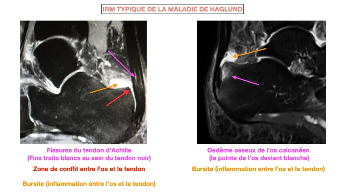 IRM montrant la maladie de Haglund : fissures du tendon d'Achille, conflit os-tendon et bursite.