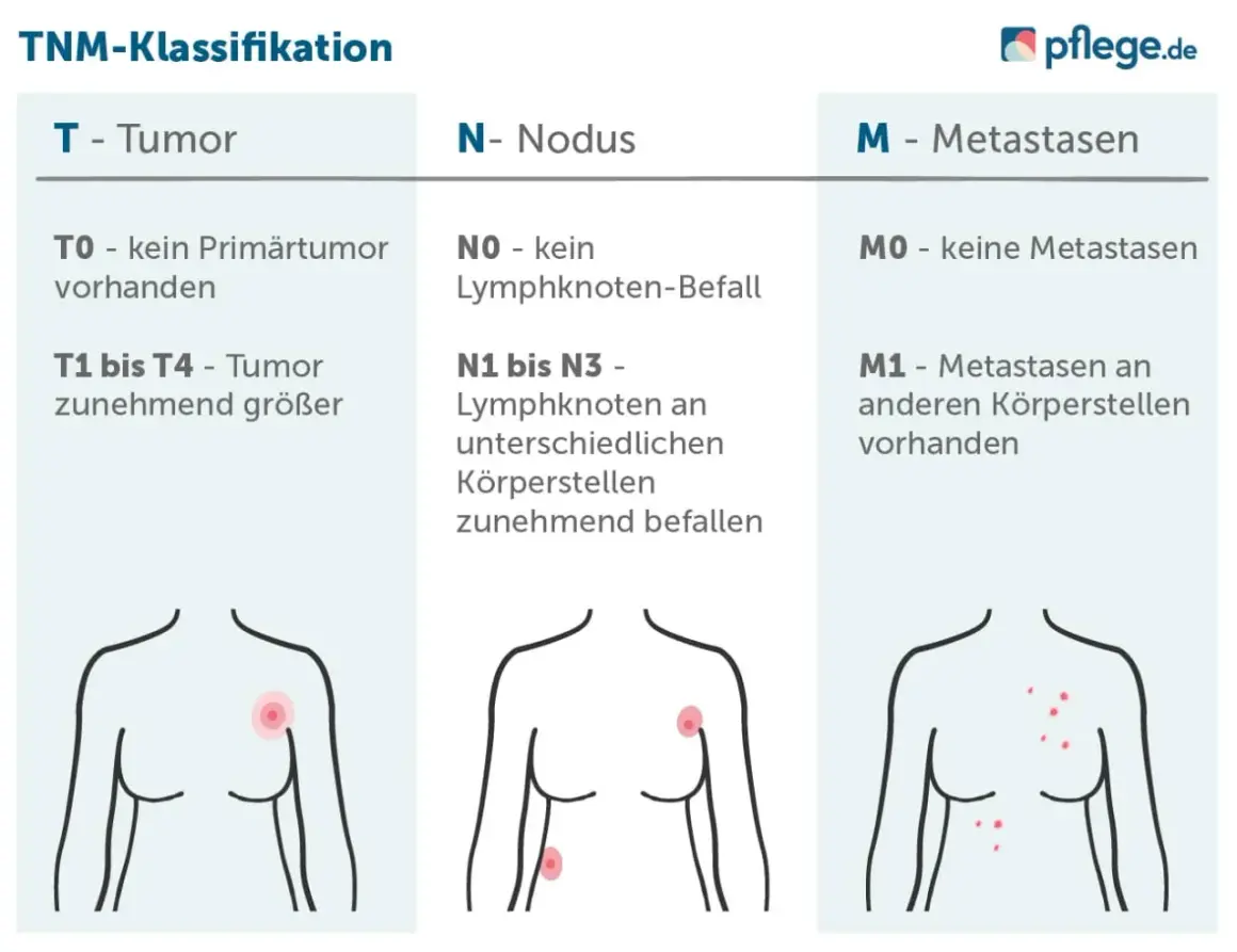 TNM-Tabelle zur Krebsklassifikation: Tumorgröße, Lymphknotenbefall und Metastasen. Wichtige Infos für die Einschätzung einer schwerbehinderung.