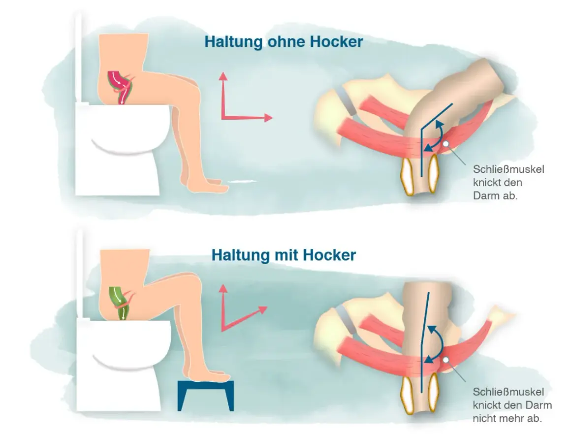 Hockstellung auf Toilette mit Hocker erleichtert den stuhlgang anregen, da der Darm gerade bleibt. Ohne Hocker wird der Darm abgeknickt.