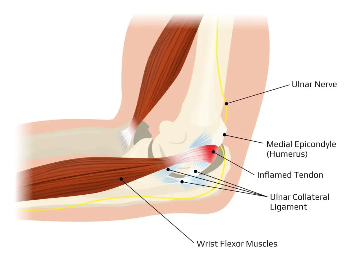 Anatomia łokcia z zapaleniem ścięgna, więzadła pobocznego łokciowego i nerwu łokciowego. Ból łokcia może być spowodowany stanem zapalnym.