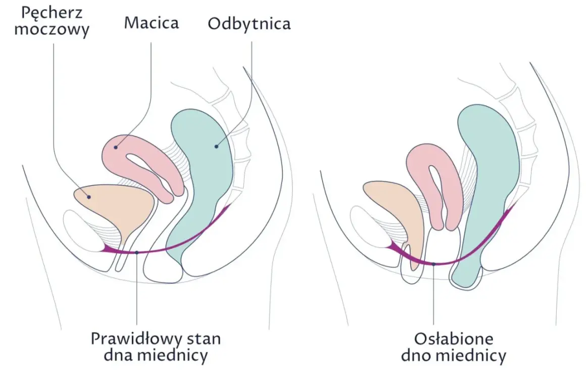Ilustracja pokazuje różnicę między prawidłowym a osłabionym dnem miednicy. Ćwiczenia Kegla to naturalne sposoby na zwężenie pochwy i wzmocnienie mięśni.