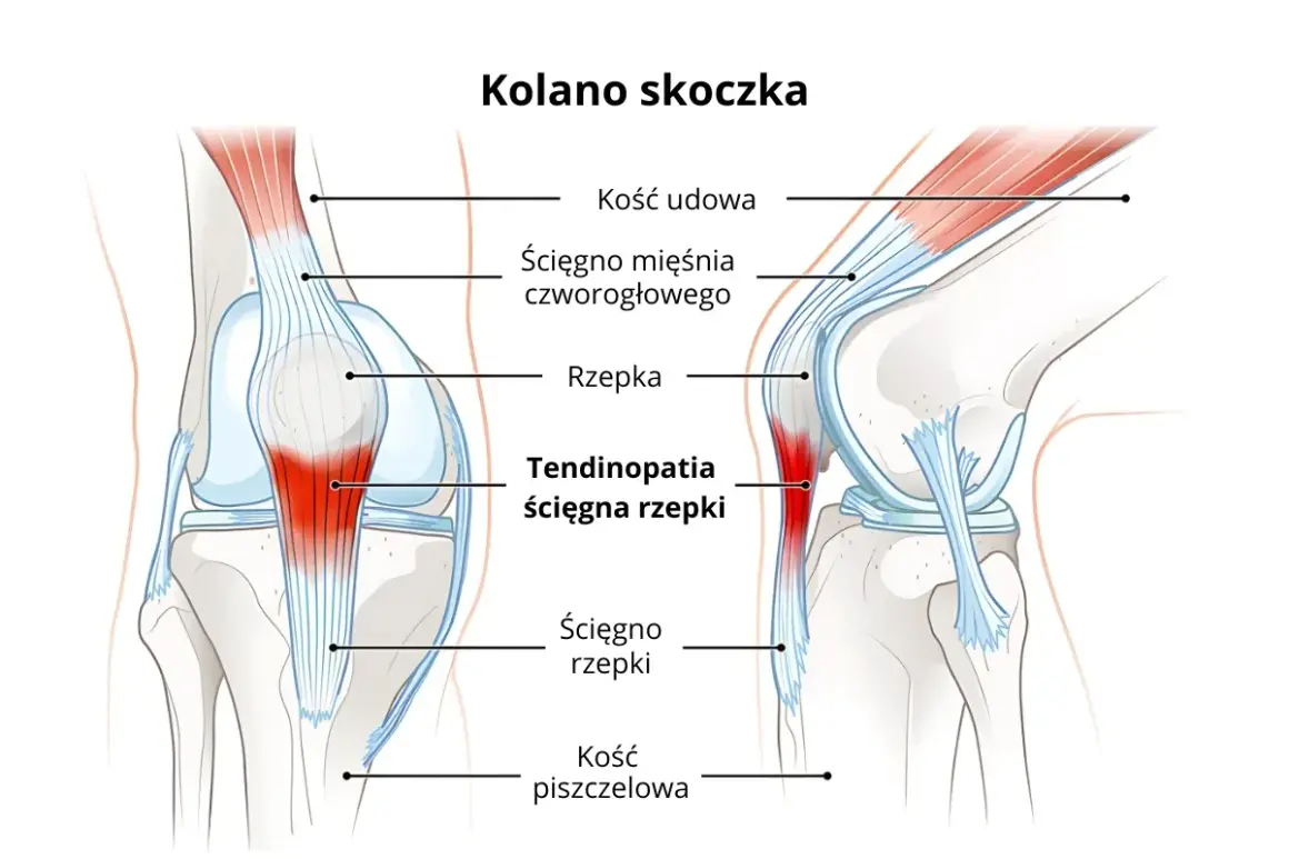 Ilustracja anatomiczna kolana z zaznaczoną rzepką i ścięgnem, z obszarem zapalenia.