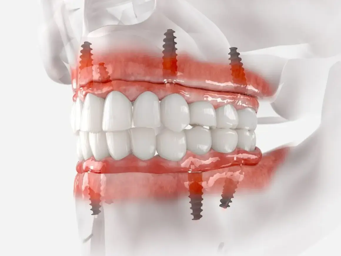 Model szczęki z implantami zygomatycznymi, pokazujący mocowanie protezy na implantach.
